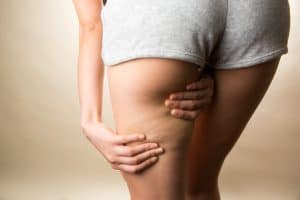 cellulite treatment scottsdale phoenix chandler